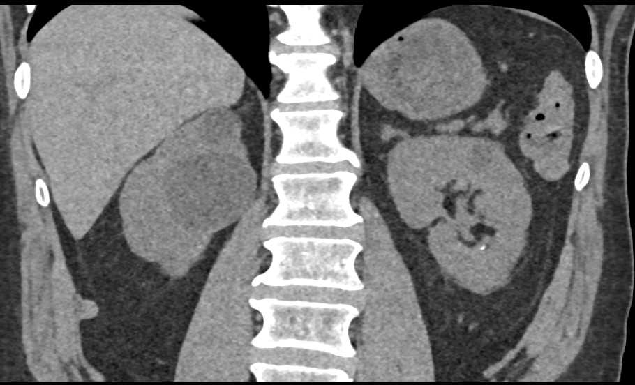 Bosniak 1 Cyst - CTisus CT Scan