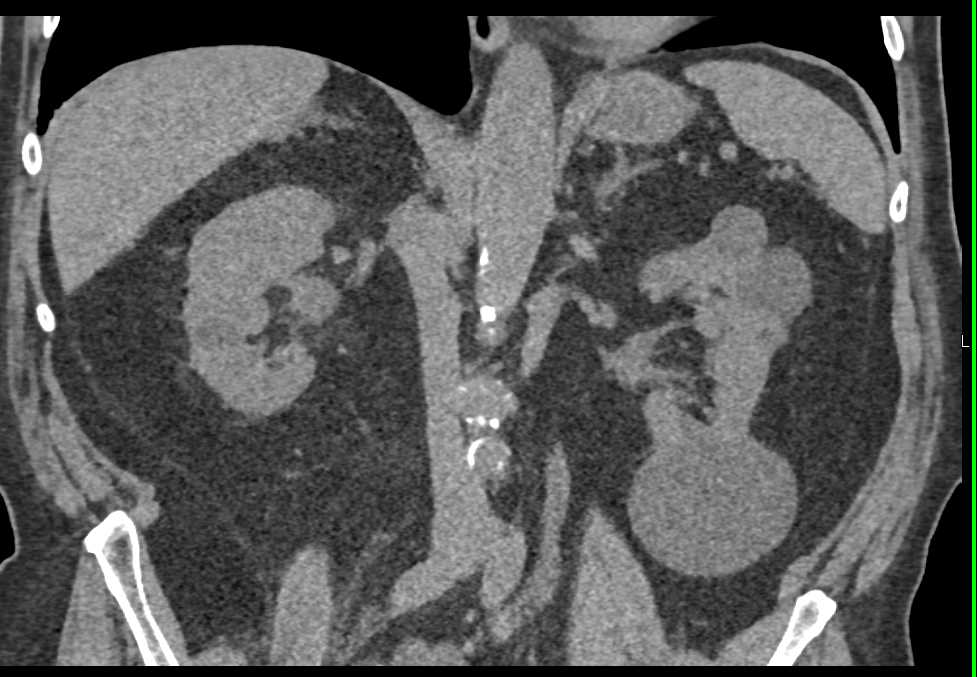 Transitional Cell Carcinoma (TCC) left Renal Pelvis with Metastases to Left Iliopsoas Muscle - CTisus CT Scan