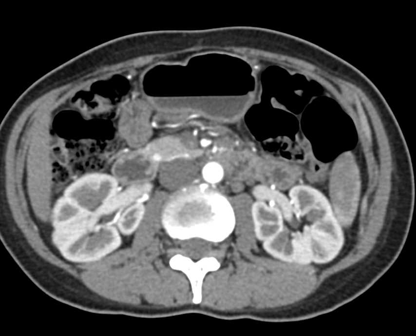 Plaque in the Renal Arteries - CTisus CT Scan