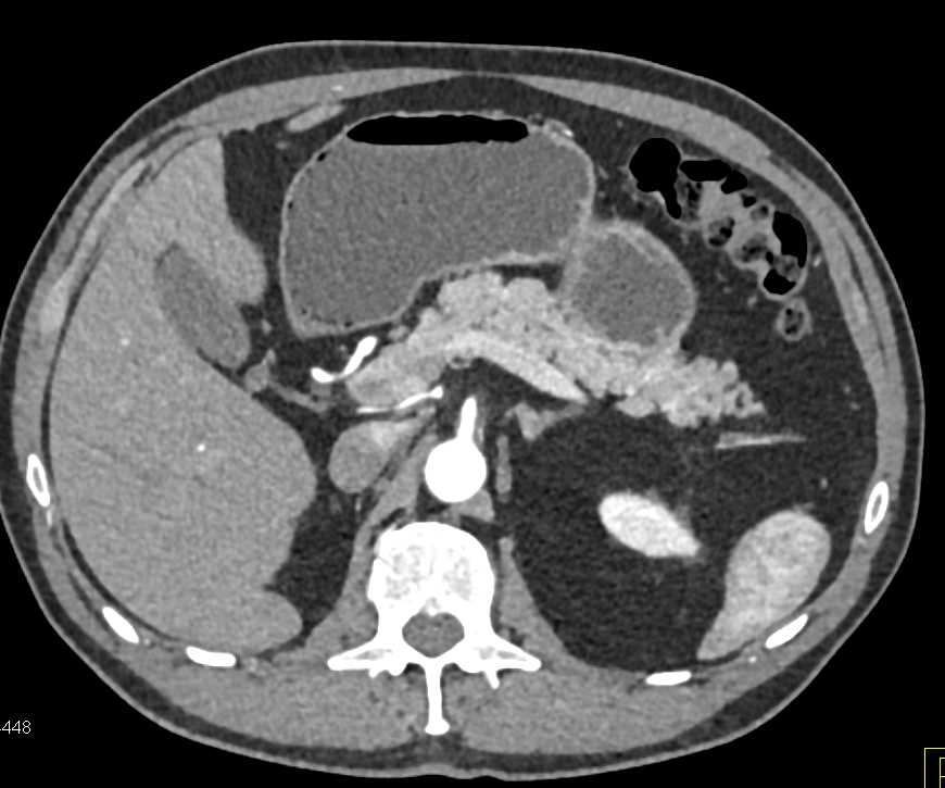 Renal Cell Carcinoma (RCC) with Right Nephrectomy and Tiny Vascular Lesions in the Pancreas (subtle) - CTisus CT Scan