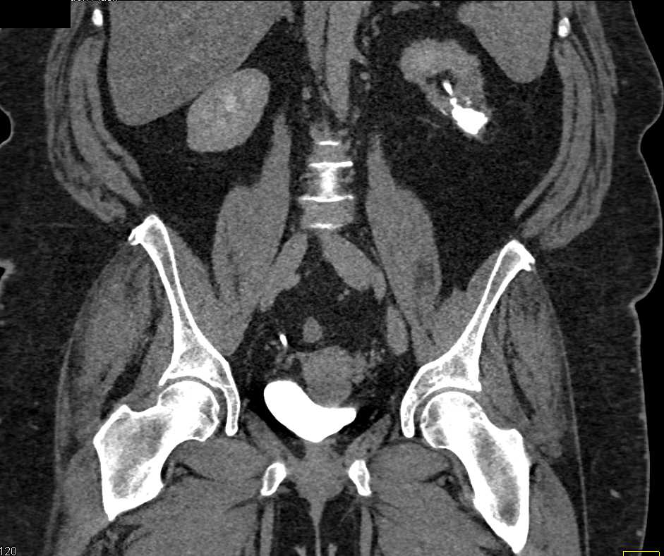 Deformed Calyx Lower Pole Left Kidney - CTisus CT Scan