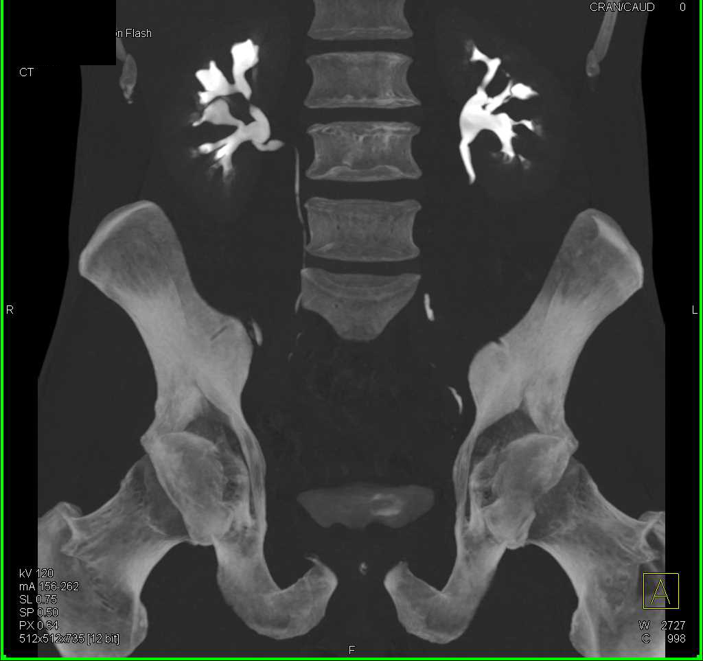 Normal Medullary Blush Kidneys - CTisus CT Scan