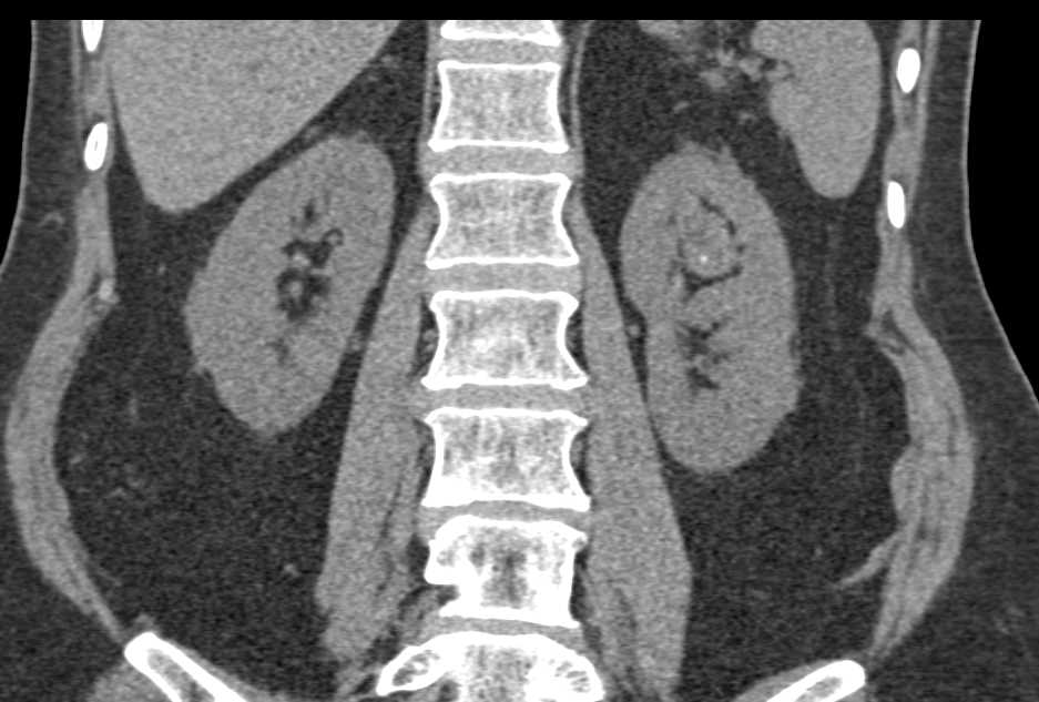 Transitional Cell Carcinoma Left Kidney Upper Pole - CTisus CT Scan