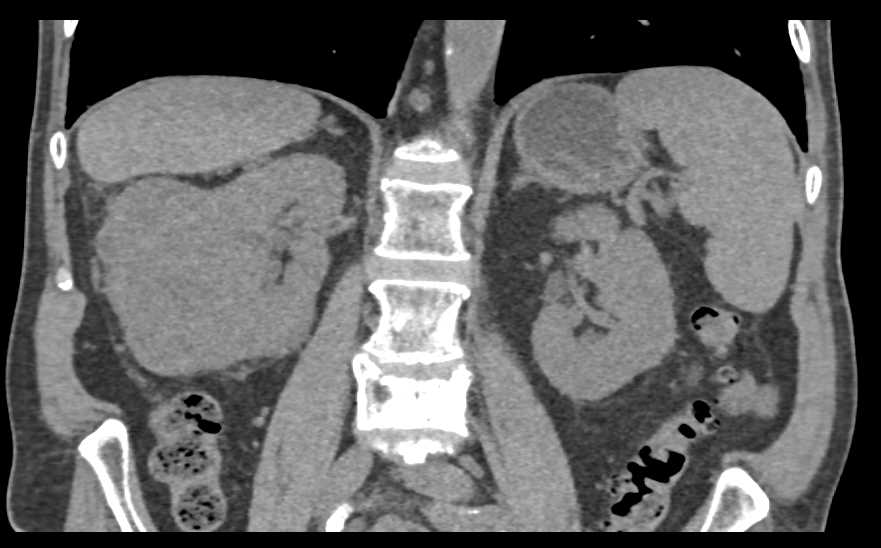 Papillary Renal Cell Carcinoma - CTisus CT Scan