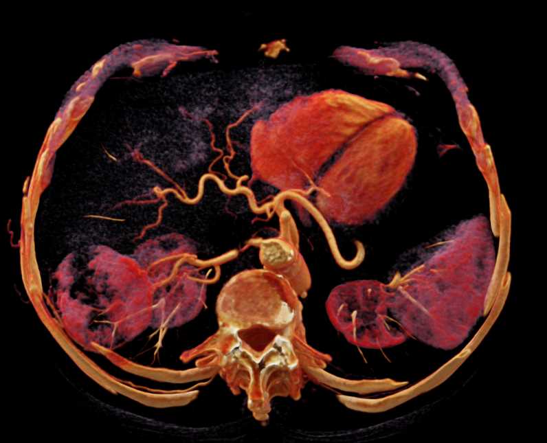 Cinematic Rendering of Right Clear Cell Renal Cell Carcinoma - CTisus CT Scan