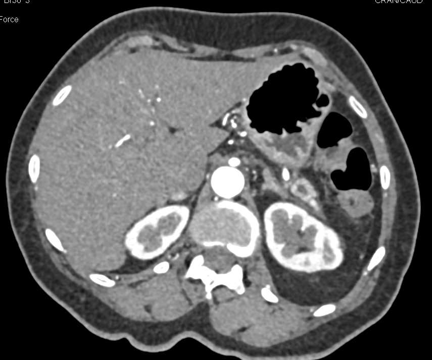 Incidental Clear Cell Renal Cell Carcinoma (RCC) Lower Pole Right Kidney - CTisus CT Scan