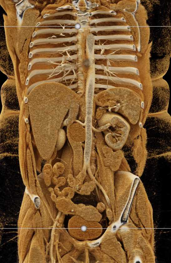 Ganglioneuroma Near Right Kidney with Cinematic Rendering - CTisus CT Scan