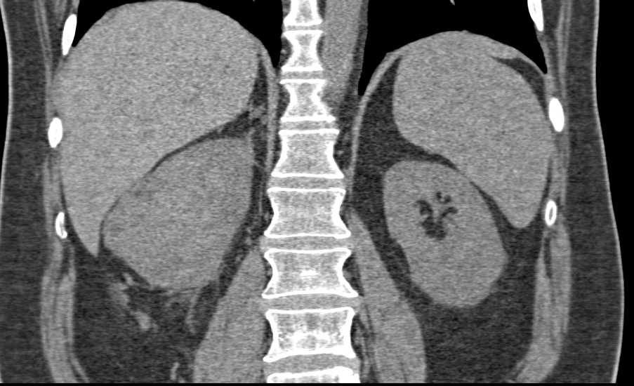 Papillary Right Renal Cell Carcinoma - CTisus CT Scan