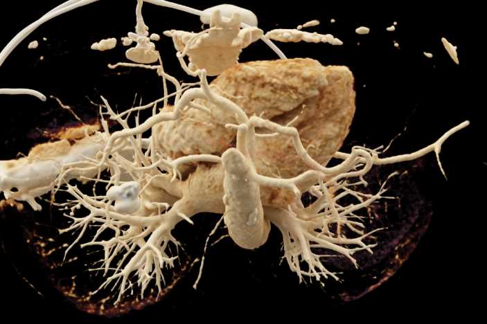 Xanthogranulomatous Pyelonephritis (XGP) Right Kidney with Cinematic Rendering - CTisus CT Scan