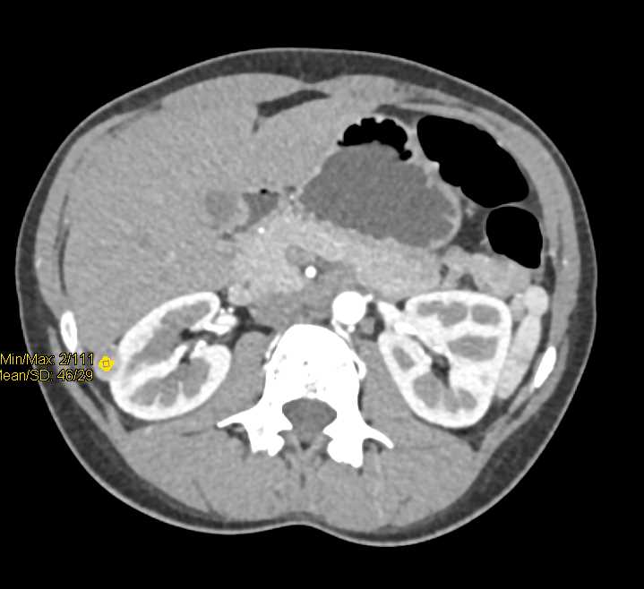 1cm Right Renal Cell Carcinoma - CTisus CT Scan