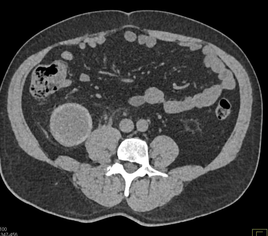Cystic Renal Cell Carcinoma Invades the Right Renal Vein - CTisus CT Scan