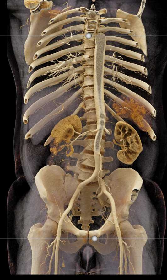 Cystic Renal Cell Carcinoma Invades the Right Renal Vein - CTisus CT Scan