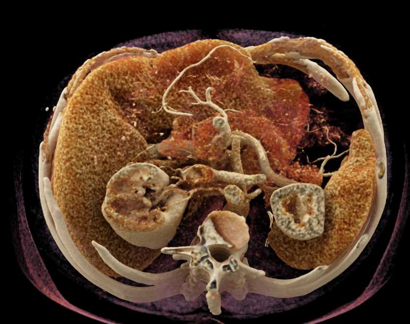 Cystic Renal Cell Carcinoma Invades the Right Renal Vein - CTisus CT Scan
