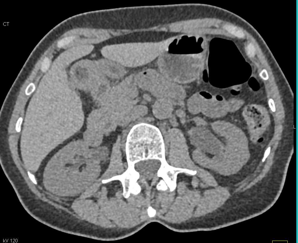 Multiple Transitional Cell Carcinomas (TCCs) Left Ureter - CTisus CT Scan