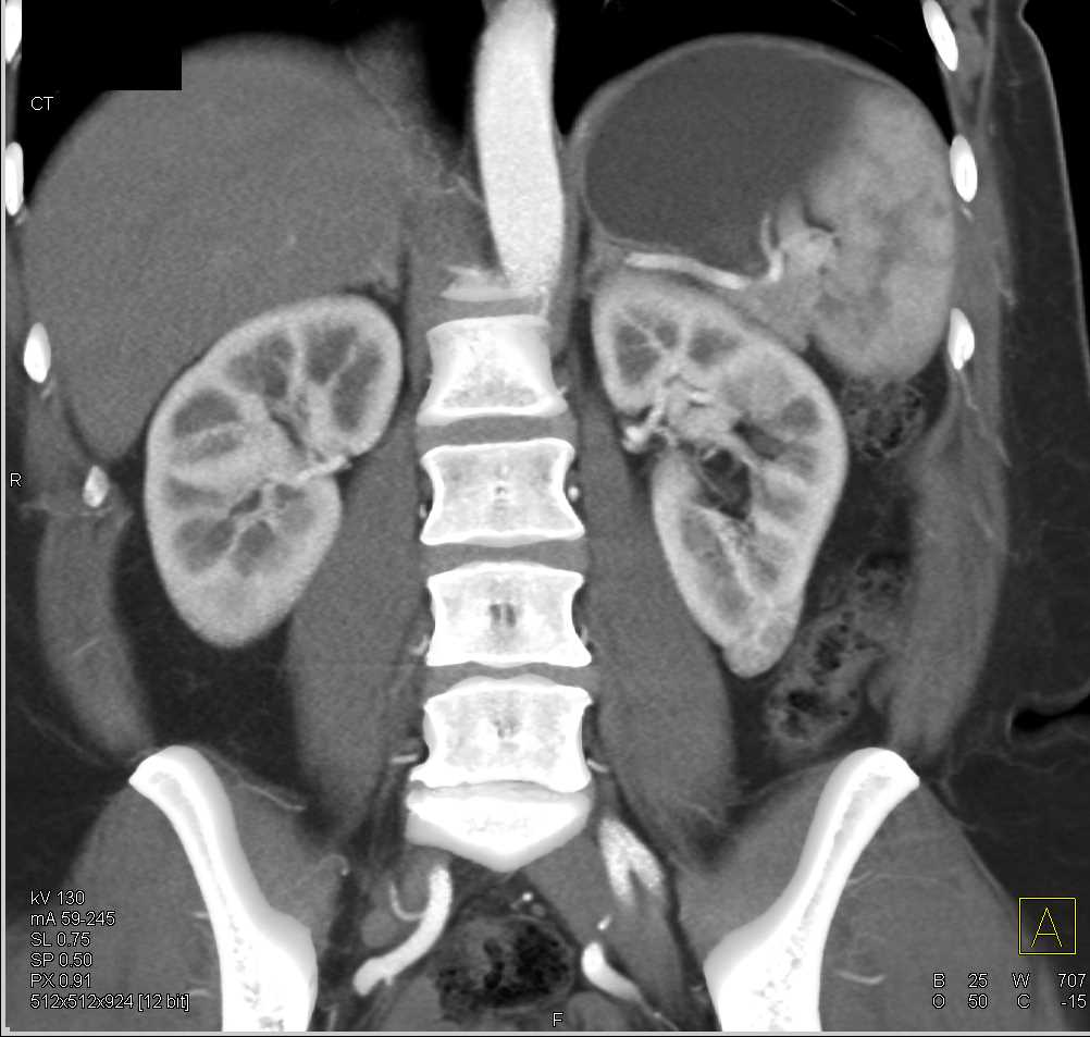 Carcinoma Lower Pole Left Kidney - CTisus CT Scan