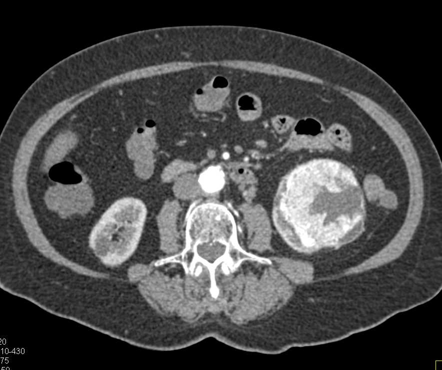 Clear Cell Carcinoma Left Kidney with Neovascularity - CTisus CT Scan