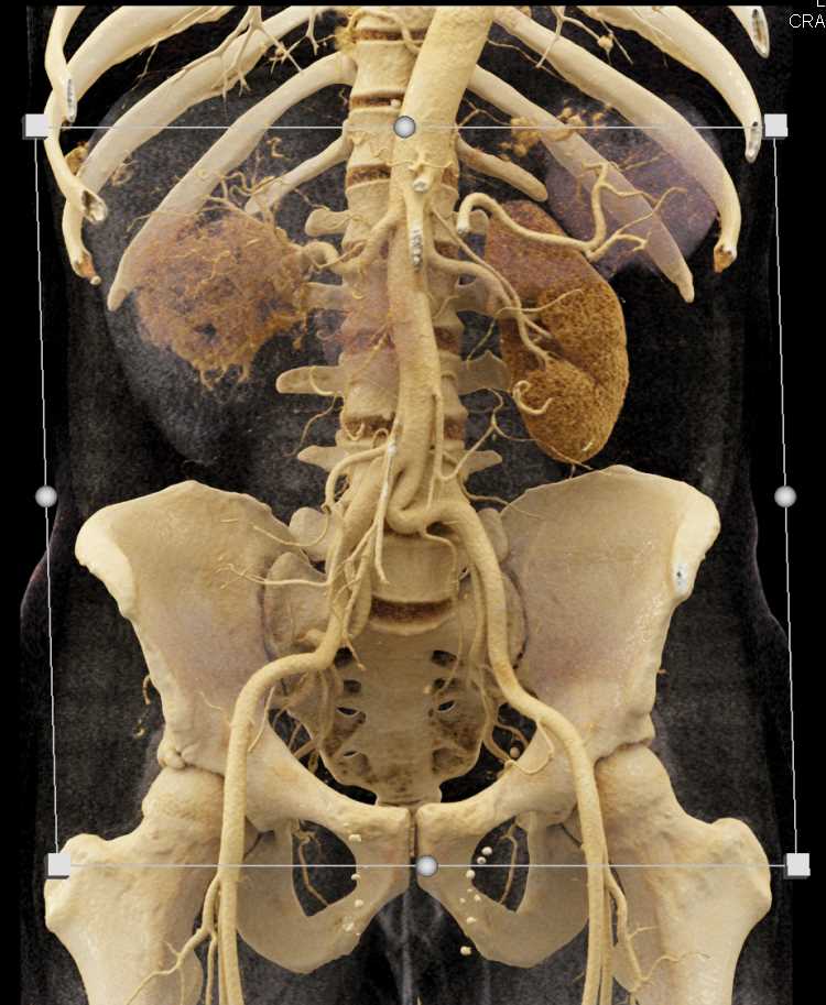 Clear Cell Renal Cell Carcinoma - CTisus CT Scan