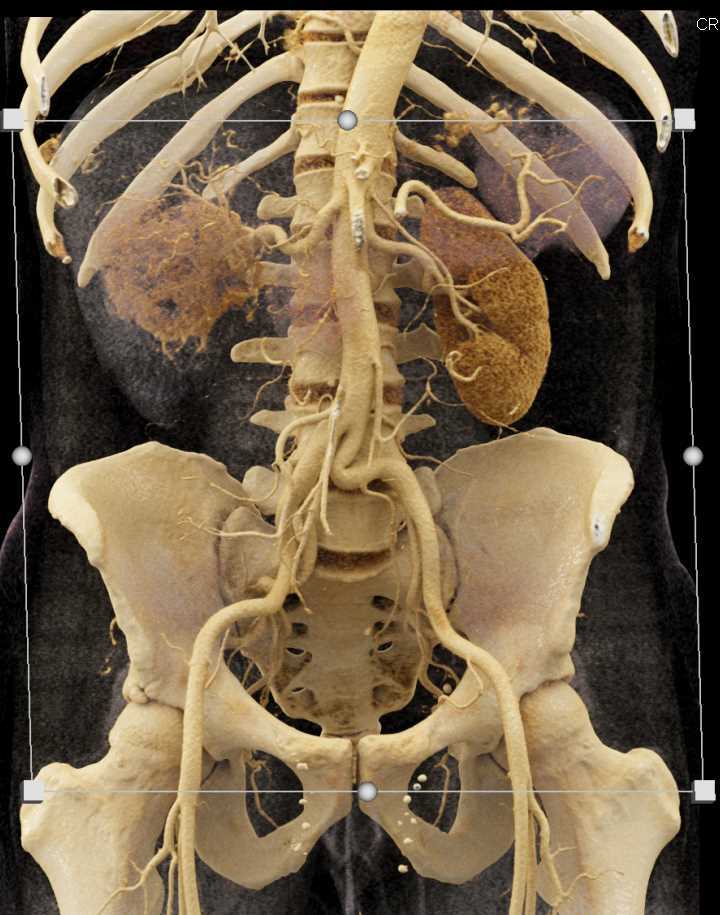 Clear Cell Renal Cell Carcinoma - CTisus CT Scan