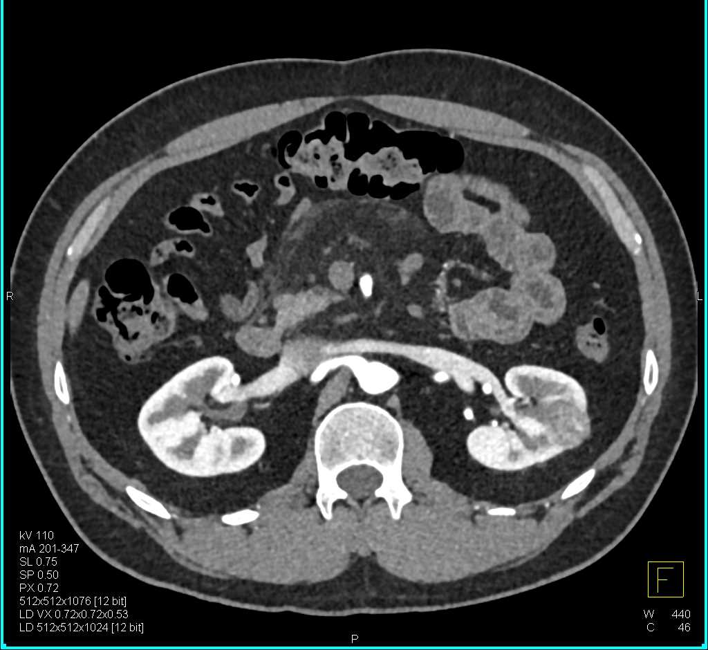 Papillary Left Renal Cell Carcinoma - CTisus CT Scan