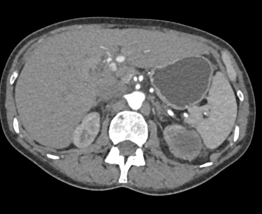 Left Renal Pyelonephritis with Abscess - CTisus CT Scan