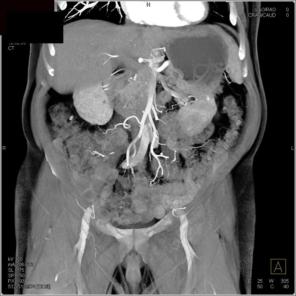 High Density Right Renal Cyst - CTisus CT Scan