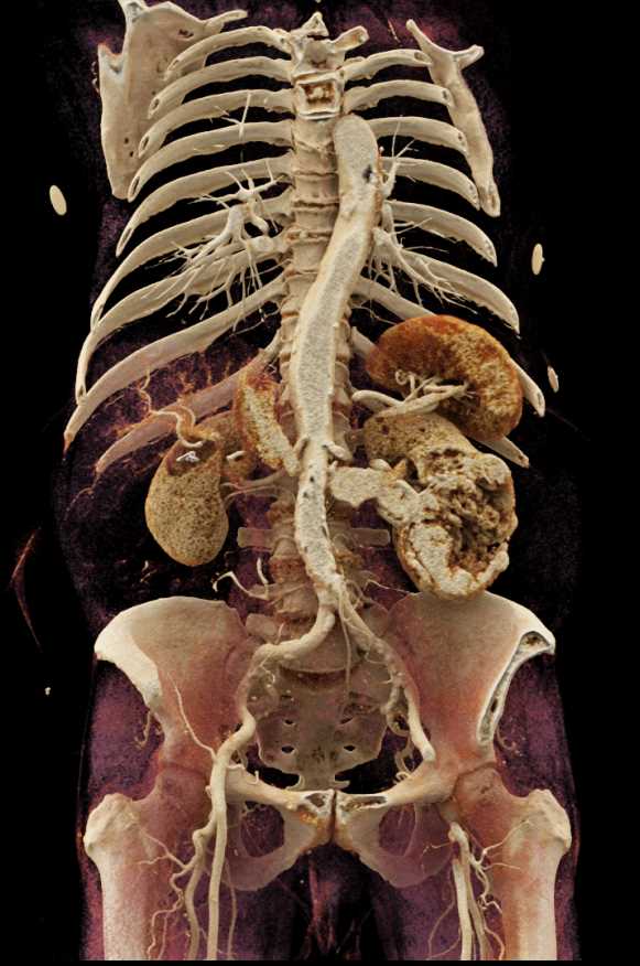 Clear Cell Renal Cell Carcinoma Invades the Left Renal Vein - CTisus CT Scan