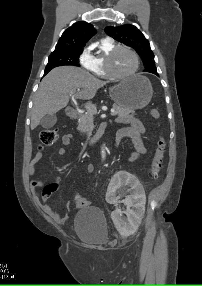 Acute Pyelonephritis in a Renal Transplant Kidney - CTisus CT Scan