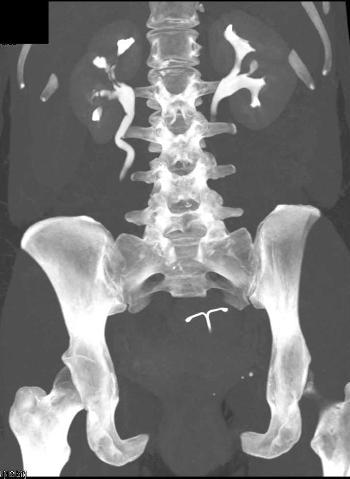 Transitional Cell Carcinoma Right Kidney - CTisus CT Scan