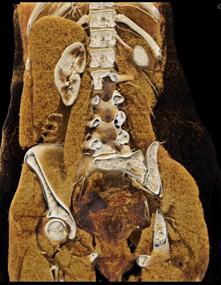 Acute Pyelonephritis Upper Pole Right Kidney - CTisus CT Scan