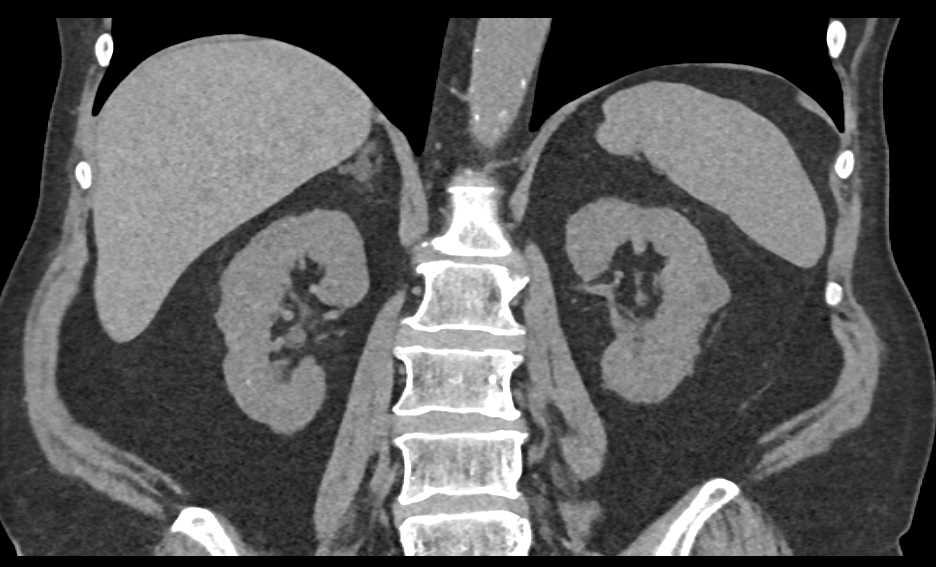 Multiple Renal Cysts - CTisus CT Scan