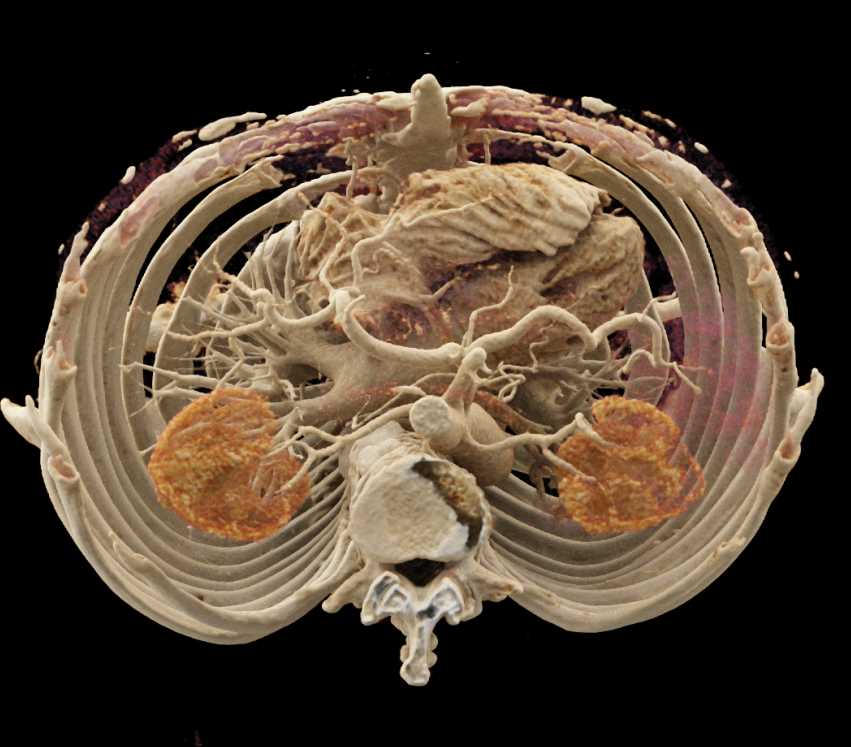 Erdheim Chester Disease Involves Aorta and Kidneys - CTisus CT Scan