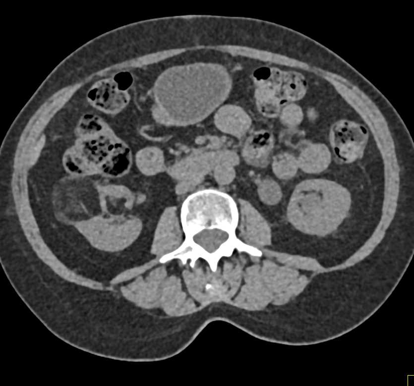 Right Renal Angiomyolipoma - CTisus CT Scan