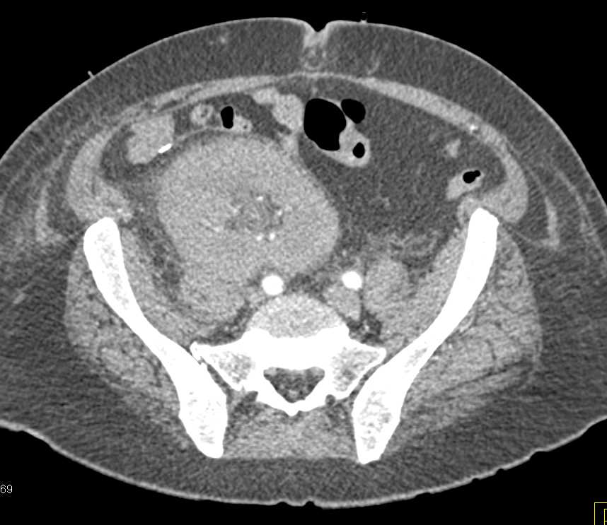 Failing Right Renal Transplant - CTisus CT Scan