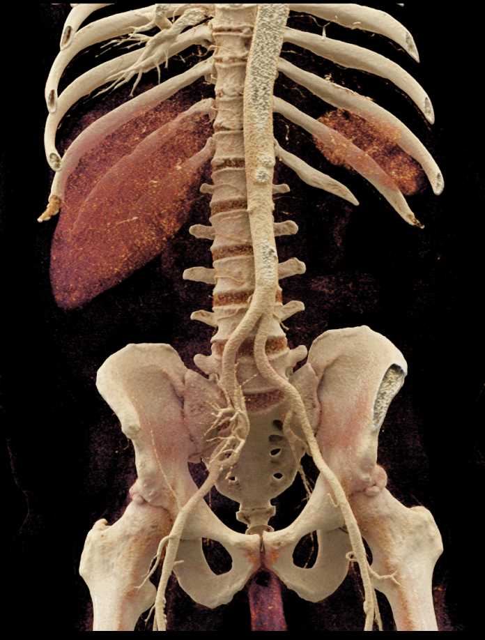Failing Right Renal Transplant - CTisus CT Scan