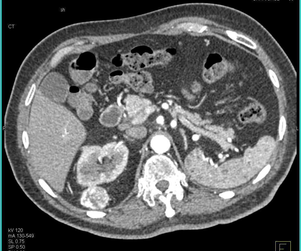 Metastatic Renal Cell Carcinoma to the Pancreas and Perirenal Space - CTisus CT Scan