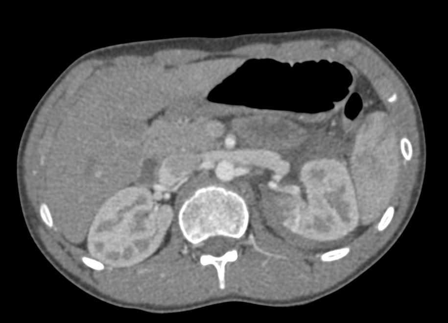 Renal Laceration Left Kidney - CTisus CT Scan