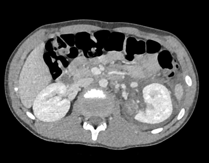 Renal Laceration Left Kidney with Peri-renal Bleed - CTisus CT Scan