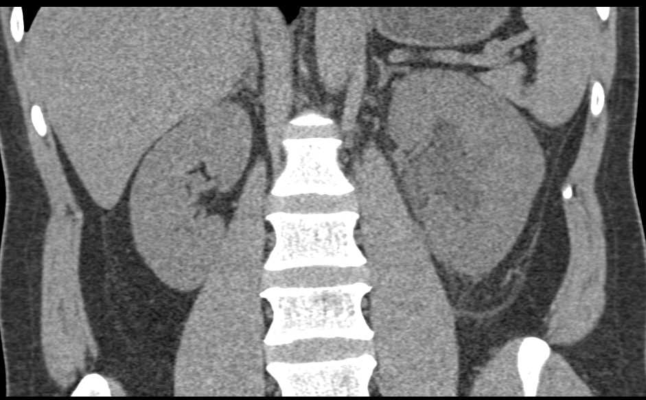 Left Hydronephrosis and Delayed Function Left Kidney - CTisus CT Scan