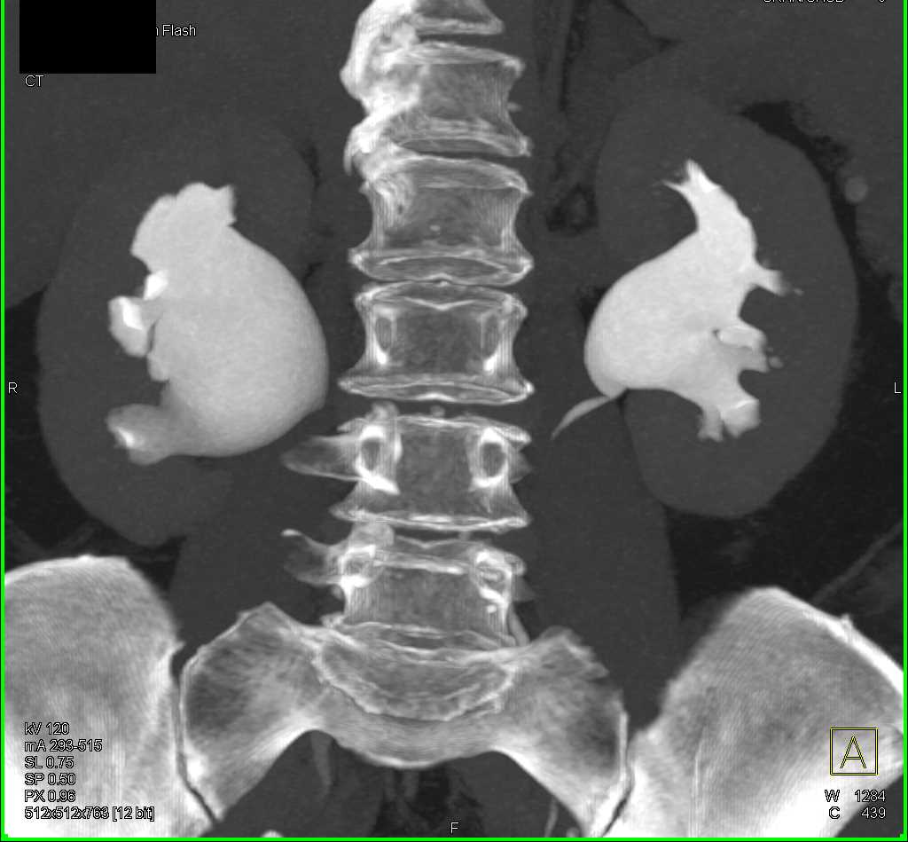 Bilateral Ureteropelvic Junctions (UPJs) - CTisus CT Scan