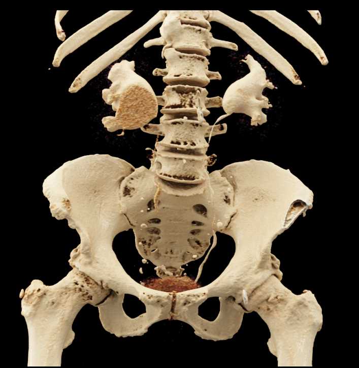 Bilateral Ureteropelvic Junctions (UPJs) with Cinematic rendering - CTisus CT Scan