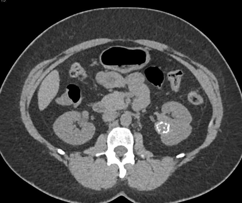 Calcified Cyst Left Kidney - CTisus CT Scan