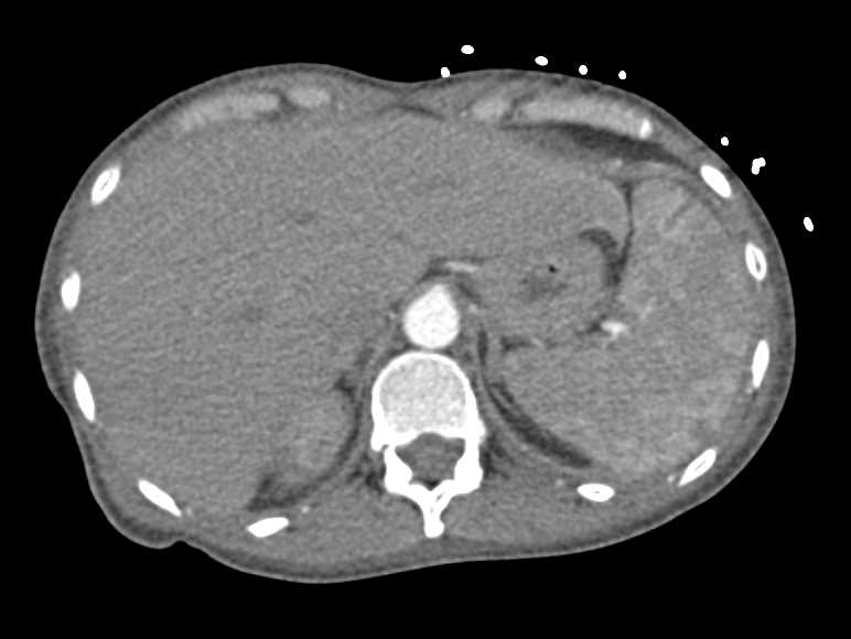 Splenic and Renal Infarcts - CTisus CT Scan