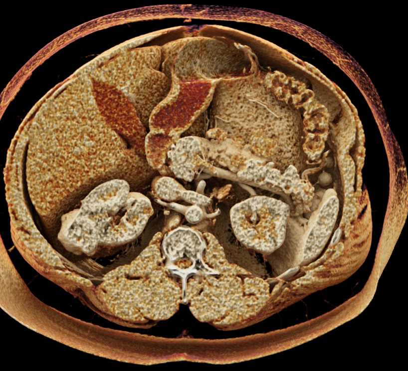 Papillary Renal Cell Carcinoma Right Kidney - CTisus CT Scan