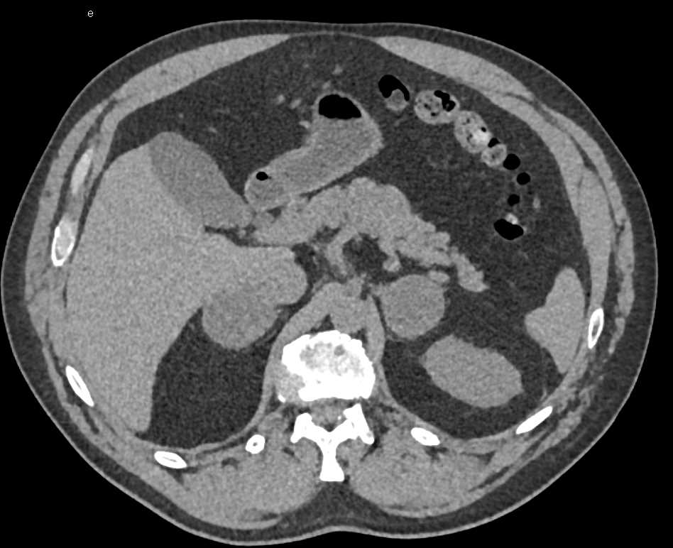 Metastatic Renal Cell Carcinoma to Adrenals and Lung - CTisus CT Scan