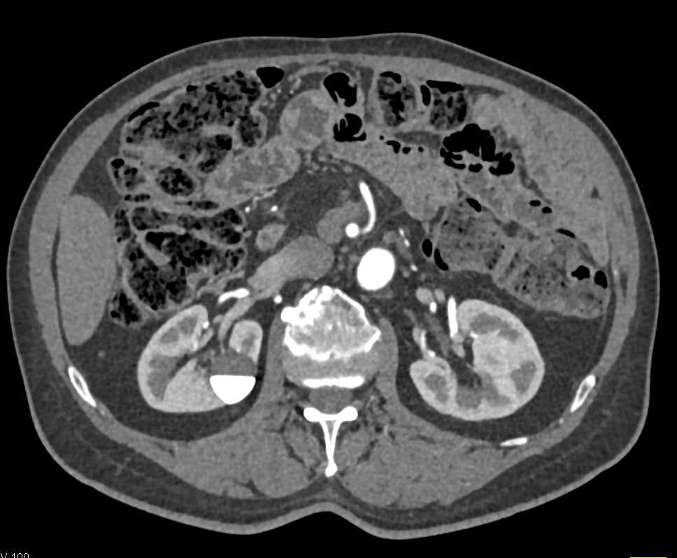 Contrast Layering in a Calyceal Diverticulum - CTisus CT Scan