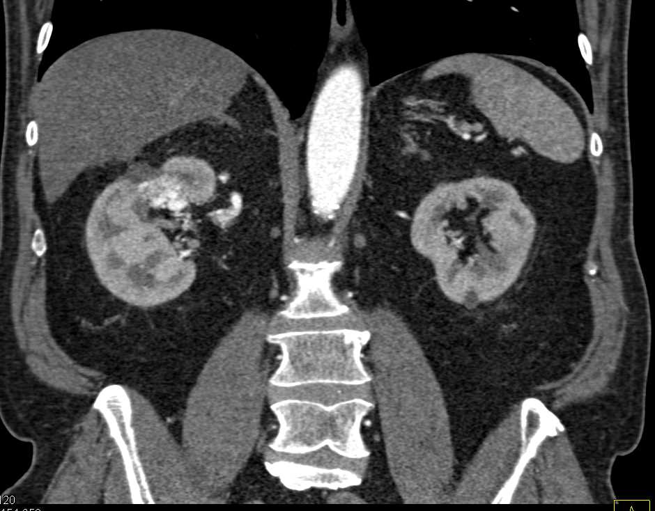 Transitional Cell Carcinoma - CTisus CT Scan