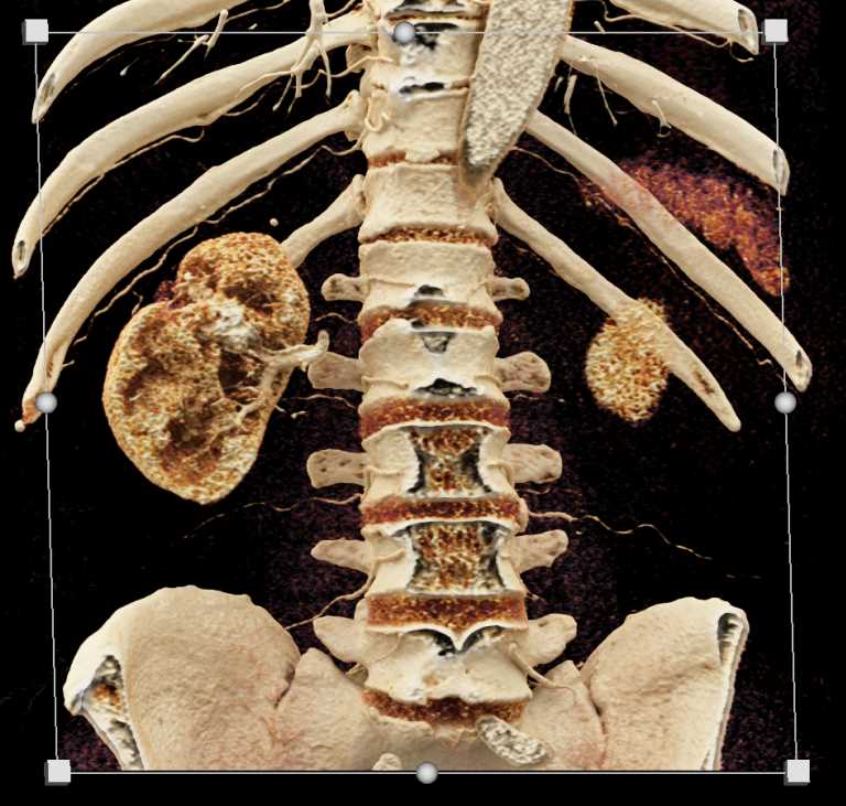 Transitional Cell Carcinoma - CTisus CT Scan