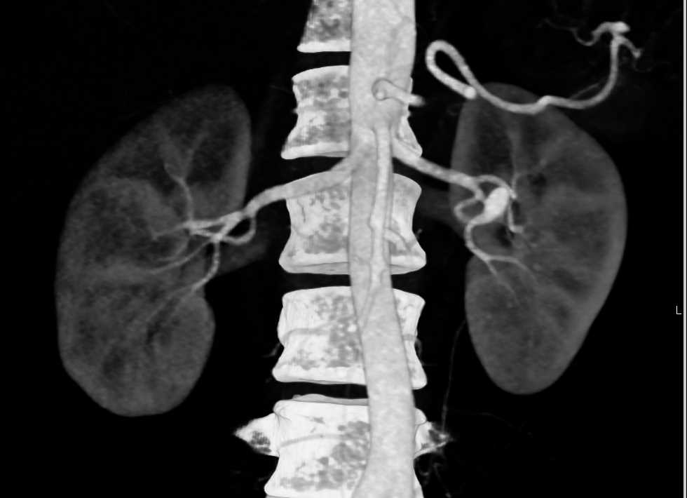 Left Renal Artery Aneurysm - CTisus CT Scan