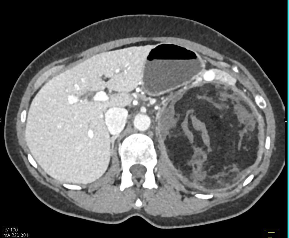 Embolization of a Left Renal Angiomyolipoma (AML) - CTisus CT Scan