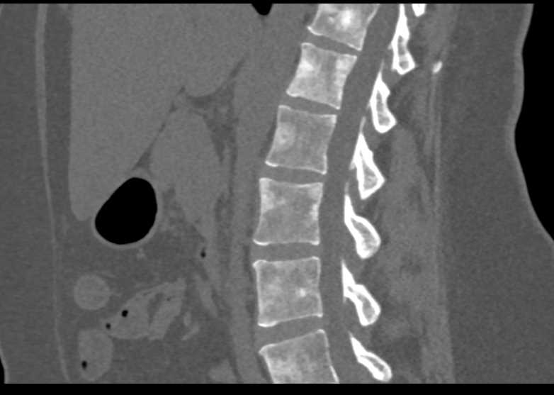 Renal Cell Carcinoma with Blastic Bone Metastases - CTisus CT Scan